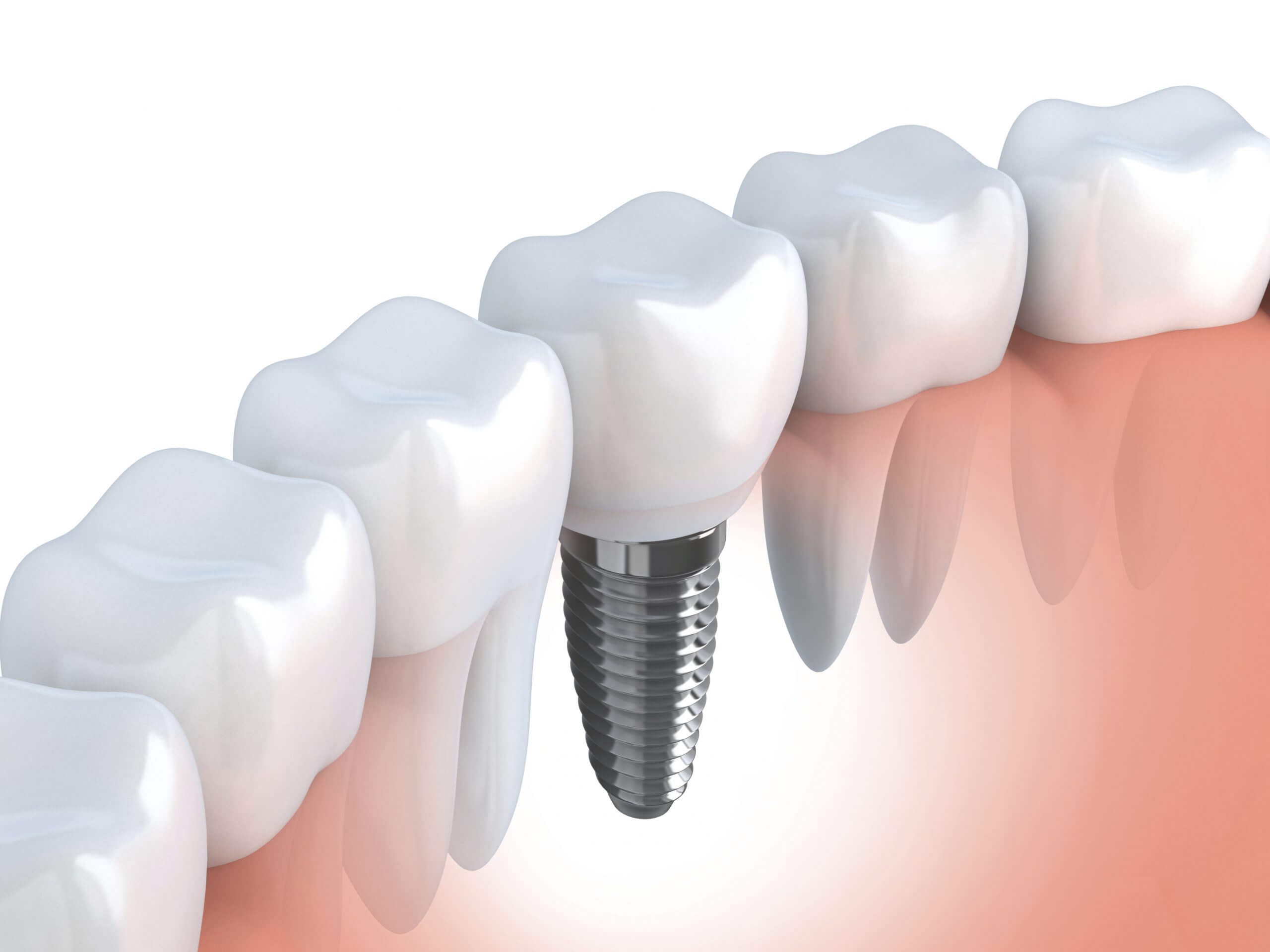 Implant dentaire chez dentiste et Cie Quebec