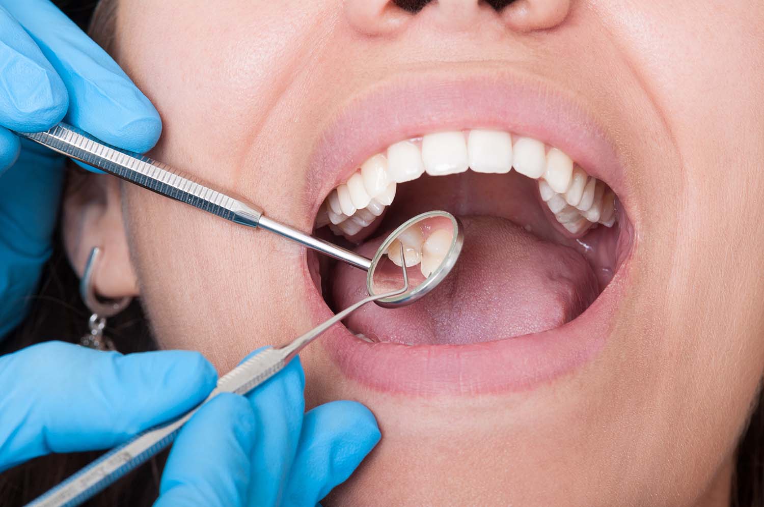 Restaurations dentaires